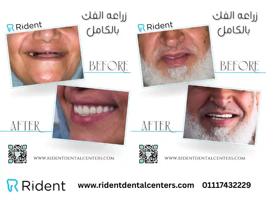 افضل مراكز زراعة الاسنان فى مصر 2025